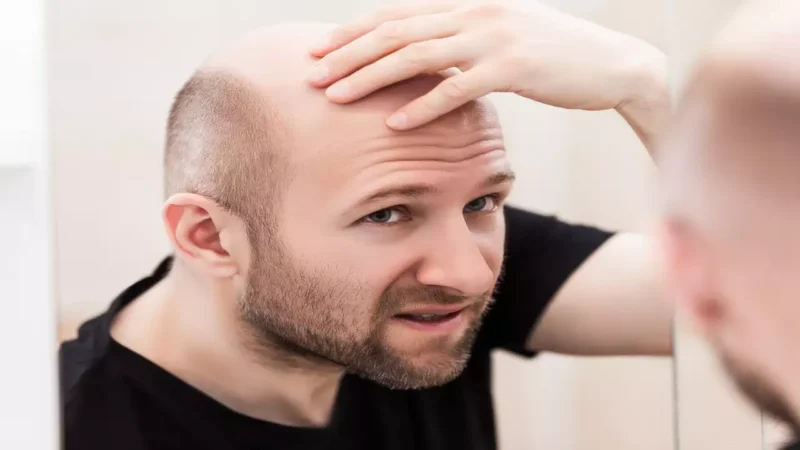 The best course of action that can help you with baldheadedness!